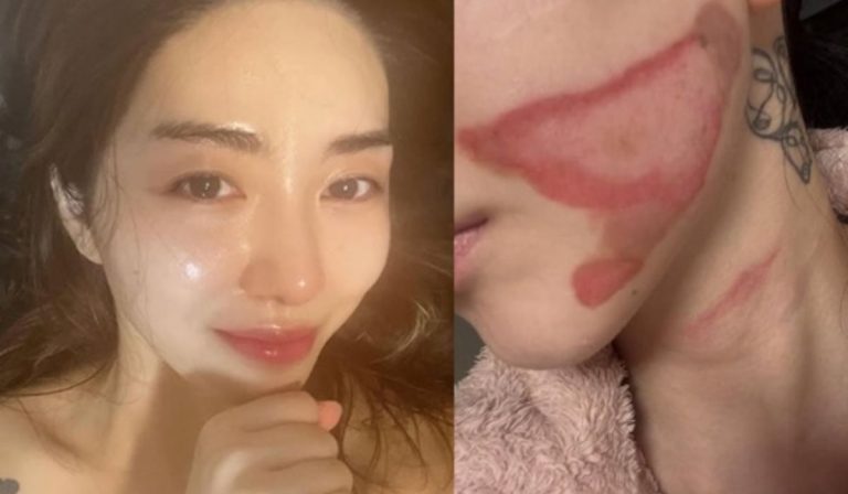 Former Kpop Idol Suffers Burn Injuries Following Skin Procedure, Shows Shocking Damage To Her Face